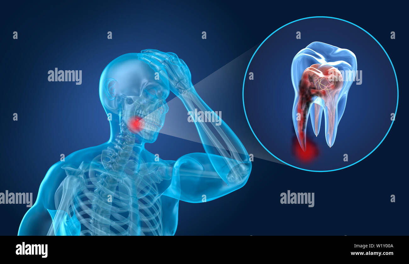 Denti dolore, l uomo che soffre di dolore di denti. 3D illustrazione Foto Stock