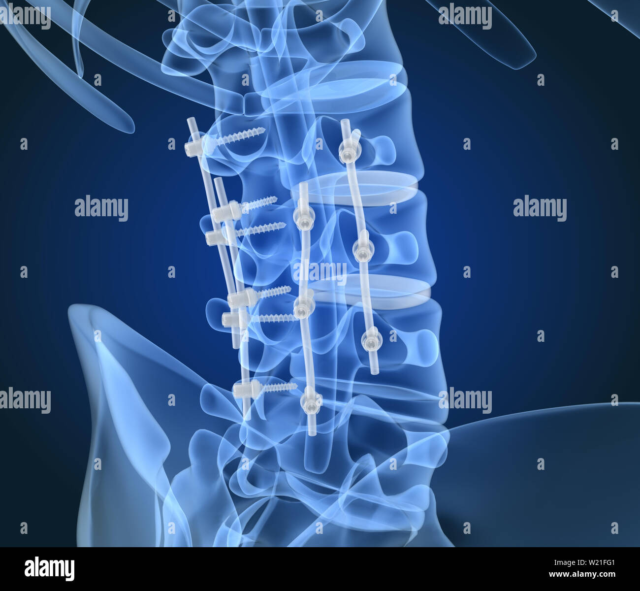Fissazione spinale sistema - staffa di titanio. X-ray 3D illustrazione Foto Stock