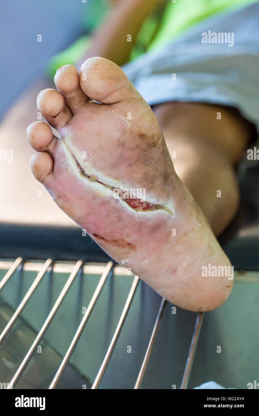 Ferita infetta del piede diabetico Foto Stock
