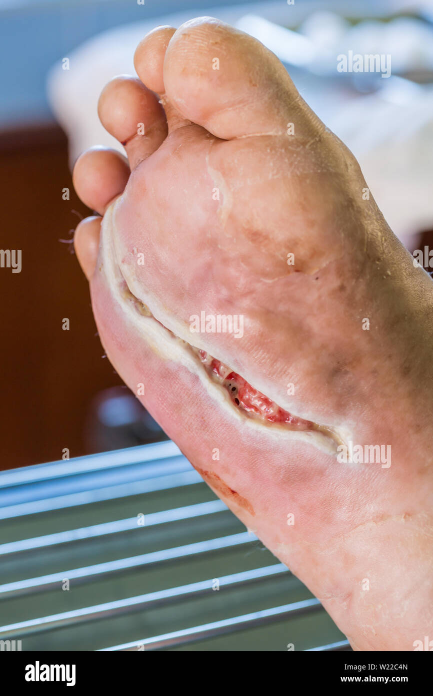 Ferita infetta del piede diabetis Foto Stock