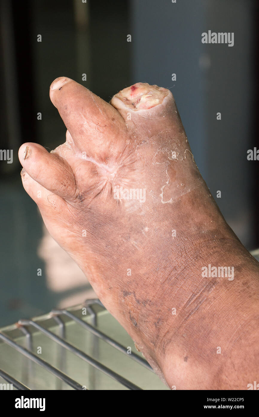 Ferita infetta del piede del diabete Foto Stock