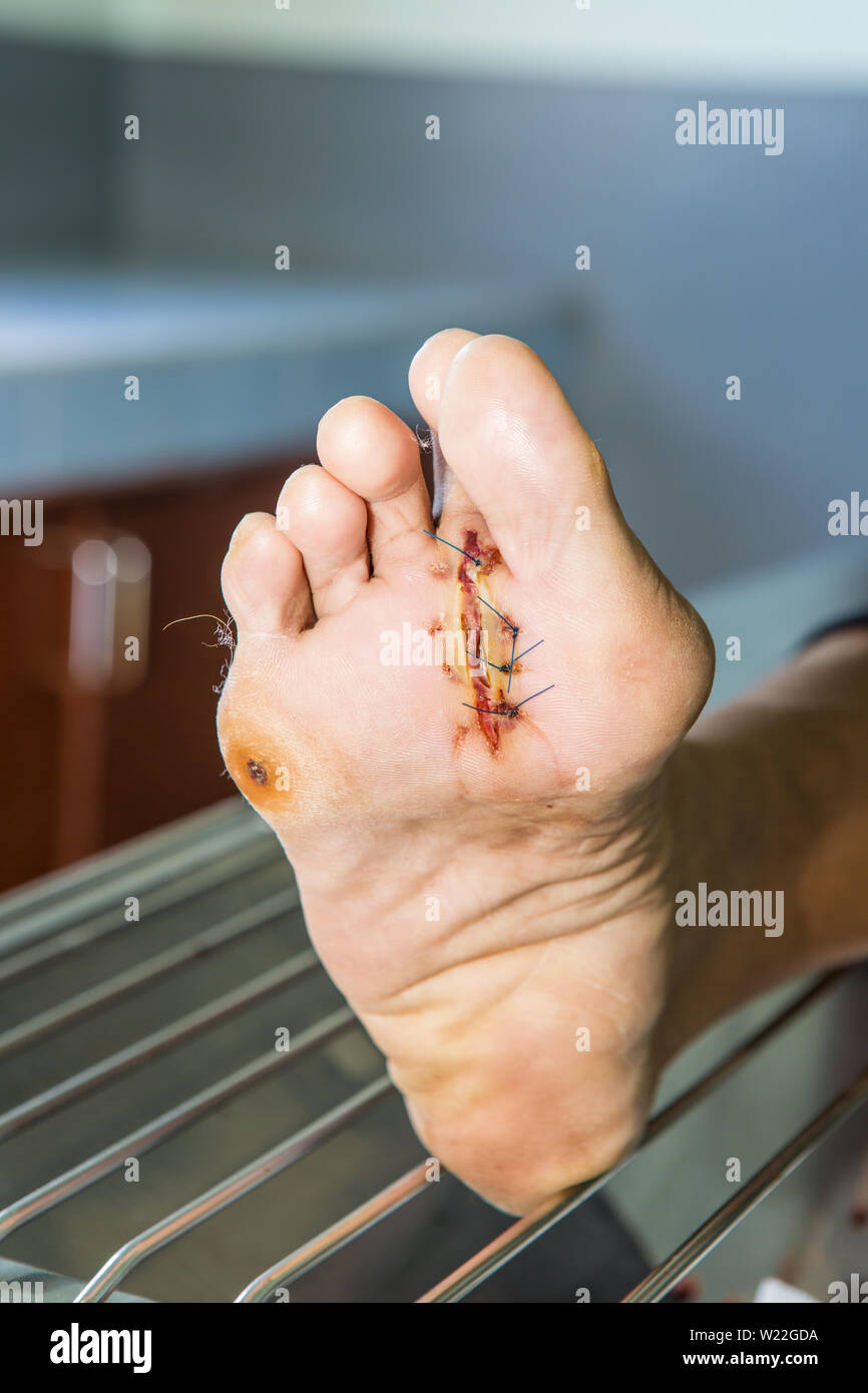 Ferita infetta del piede del diabete Foto Stock