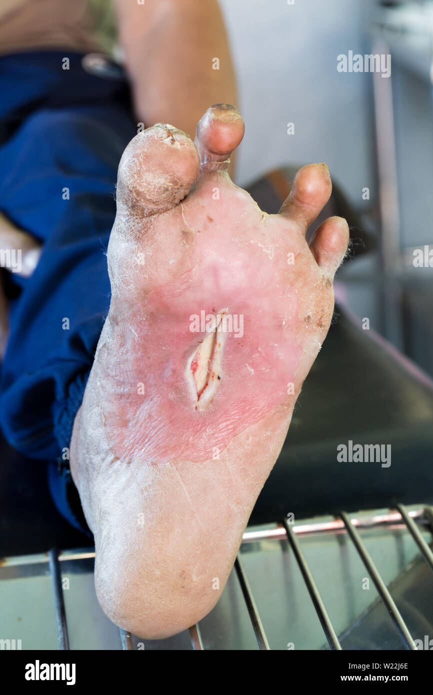 Ferita infetta del piede del diabete Foto Stock