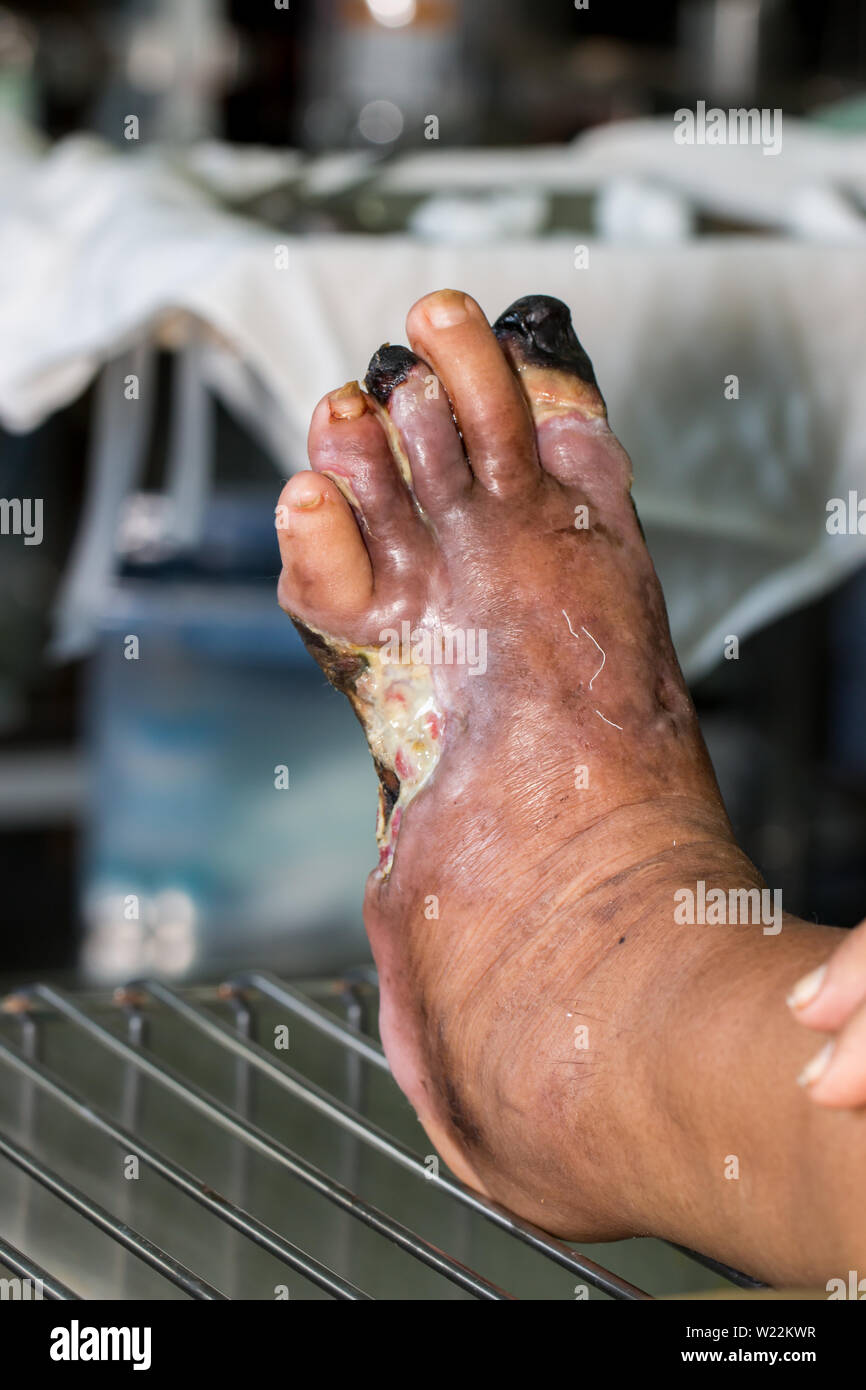 Ferita infetta del piede del diabete Foto Stock