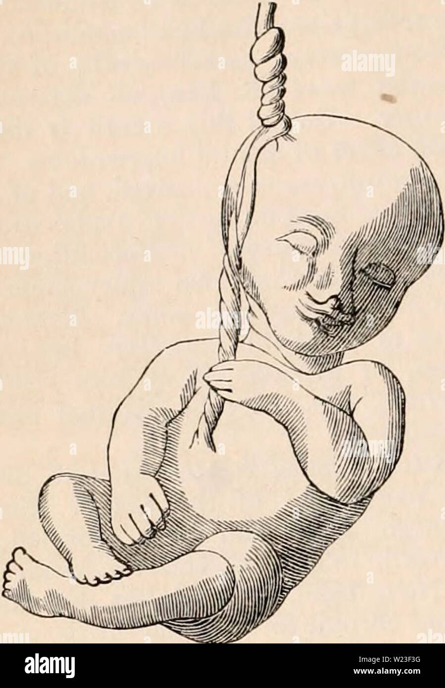 Immagine di archivio da pagina 159 della encyclopaedia - Wikizionario di anatomia e. Il encyclopaedia - Wikizionario di anatomia e fisiologia cyclopdiaofana0402todd Anno: 1849 TERATOLOGIA. la fronte, intorno al quale è attorcigliato il um- bilical cavo. Fie/. 596. Kerckring inveighed in un brioso e in- genious modo contro la strana conti che erano precedentemente dato di questi fuma. Per le malattie della placenta sono di cui allargamento (Kyll, Pierrard, Devilliers), con- gestion apoplessia e (J. Clarke, Dangan), concrezioni calcaree (Hannover). Per la cetiology di malformazioni, questa anatomia patologica della placenta è Foto Stock