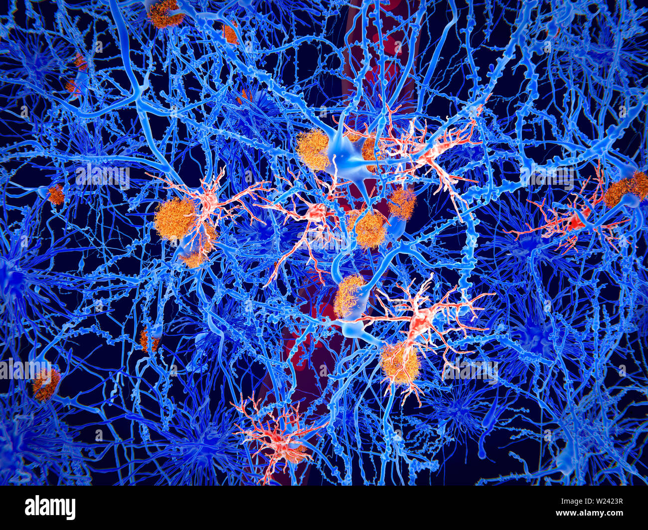 Amiloide e cellule microgliali nel morbo di Alzheimer. Illustrazione delle placche amiloidi (arancione) e cellule microgliali (rosso) tra cellule cerebrali in caso di Foto Stock