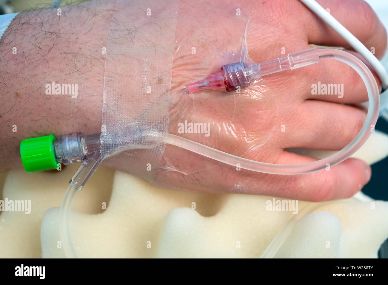 Una mano di un paziente che subisce un intervento chirurgico con una infusione di cristalloidi goung attraverso un 20G IV, una corda da un monouso ossimetro da polso in funzione della sonda acros Foto Stock