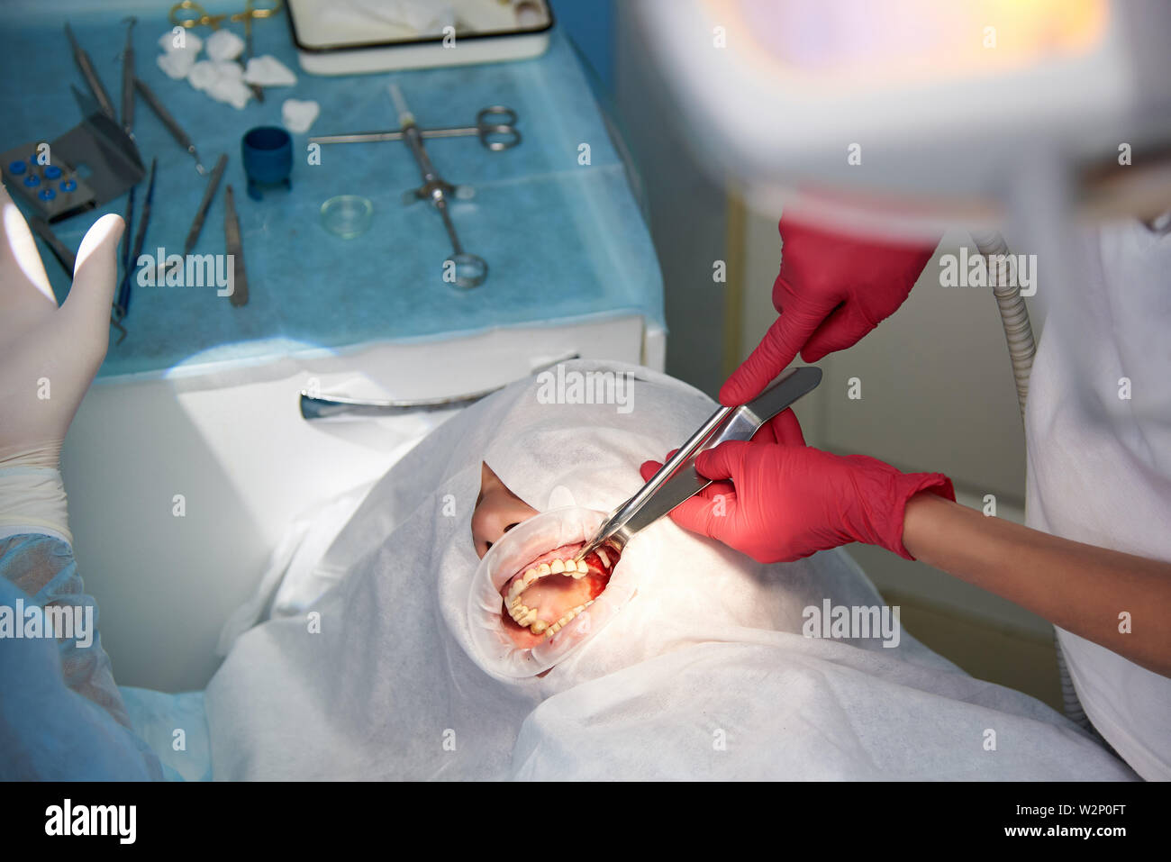 La chirurgia nella clinica dentale. Sinus operazione di sollevamento. Foto Stock