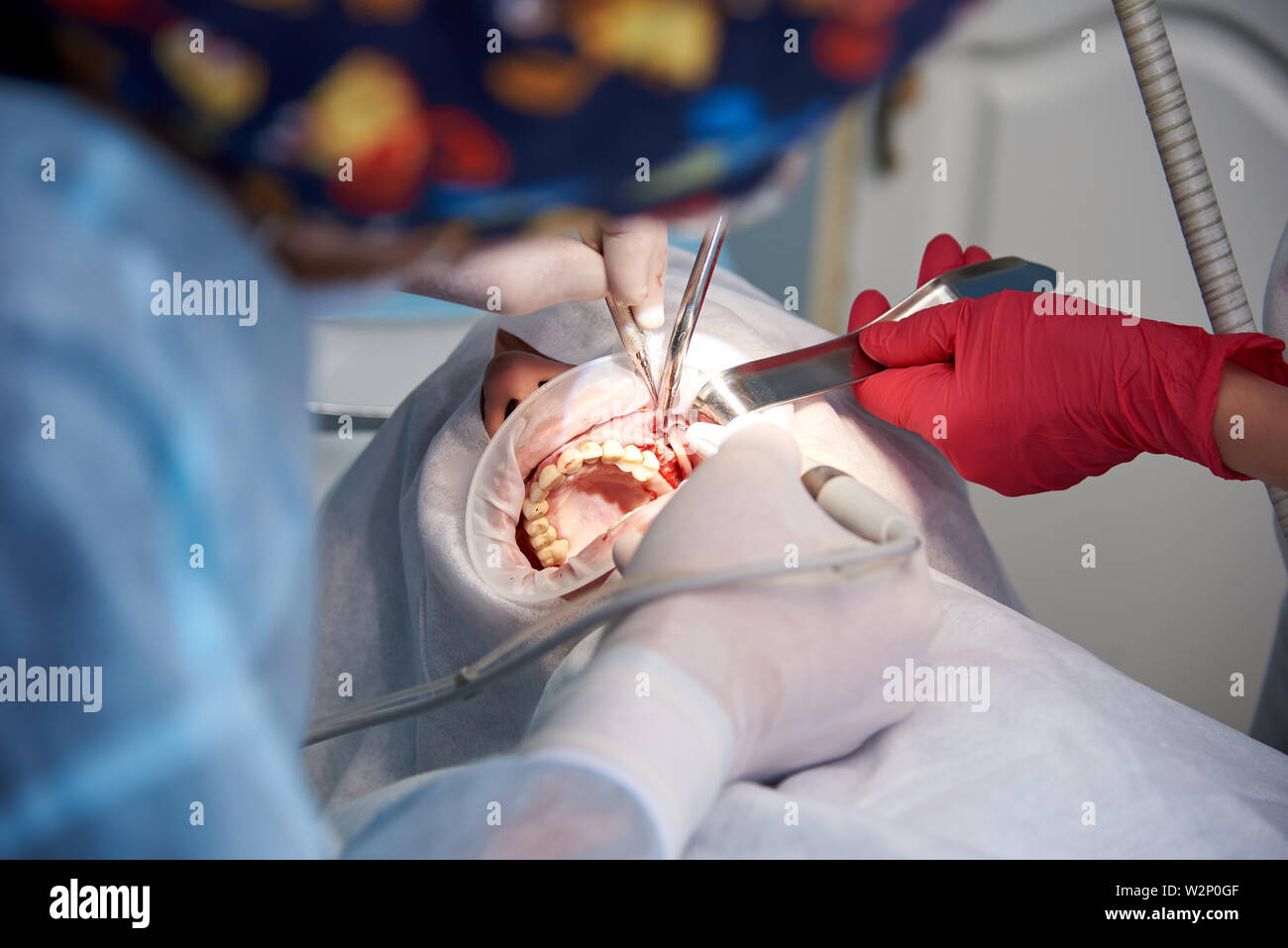 La chirurgia nella clinica dentale. Sinus operazione di sollevamento. Foto Stock