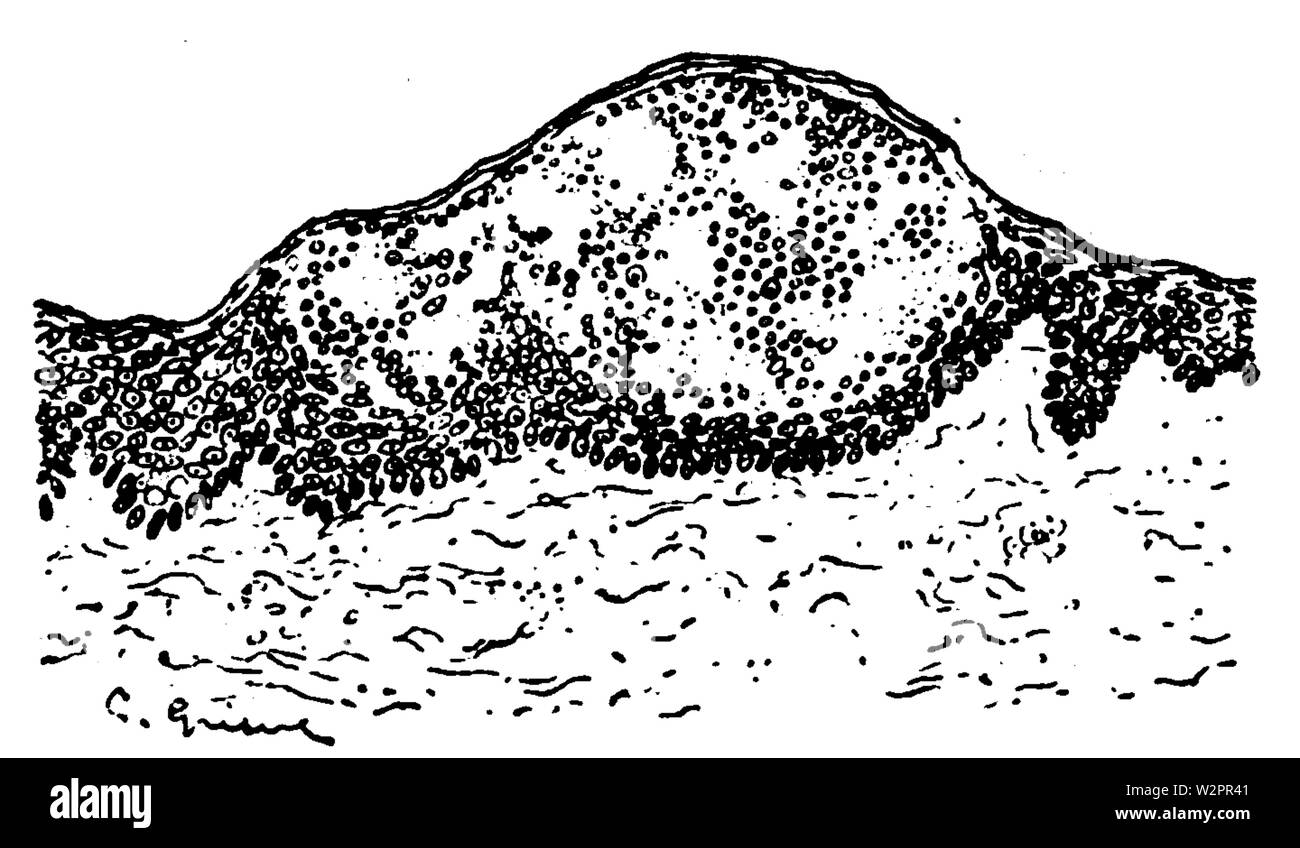 Un introduzione alla dermatologia (1905) Miliaria 80x Foto Stock