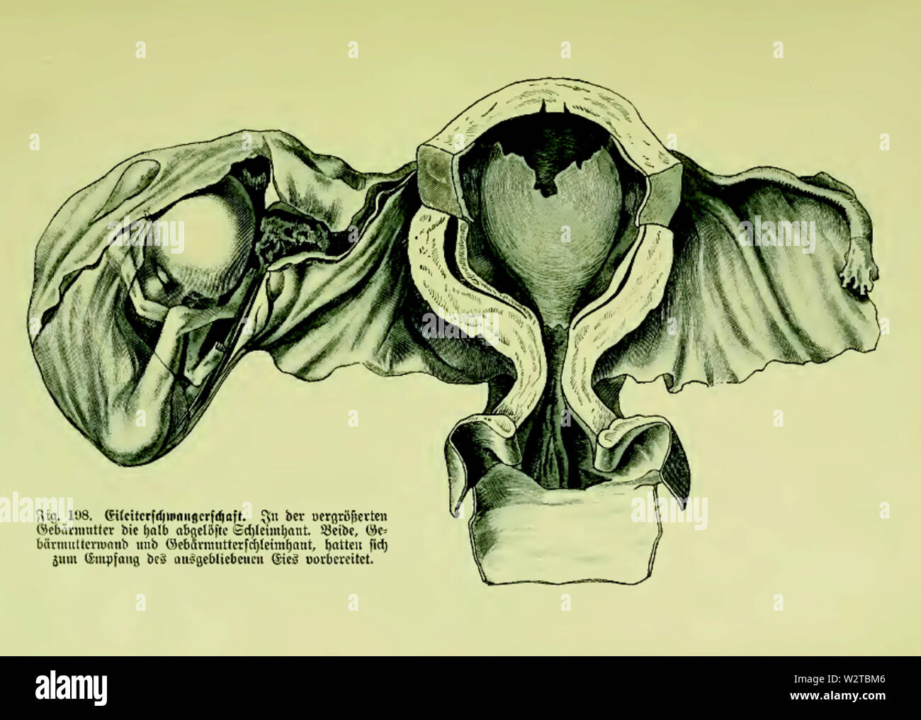 Die Frau als Hausärztin (1911) 198 Eileiterschwangerschaft Foto Stock