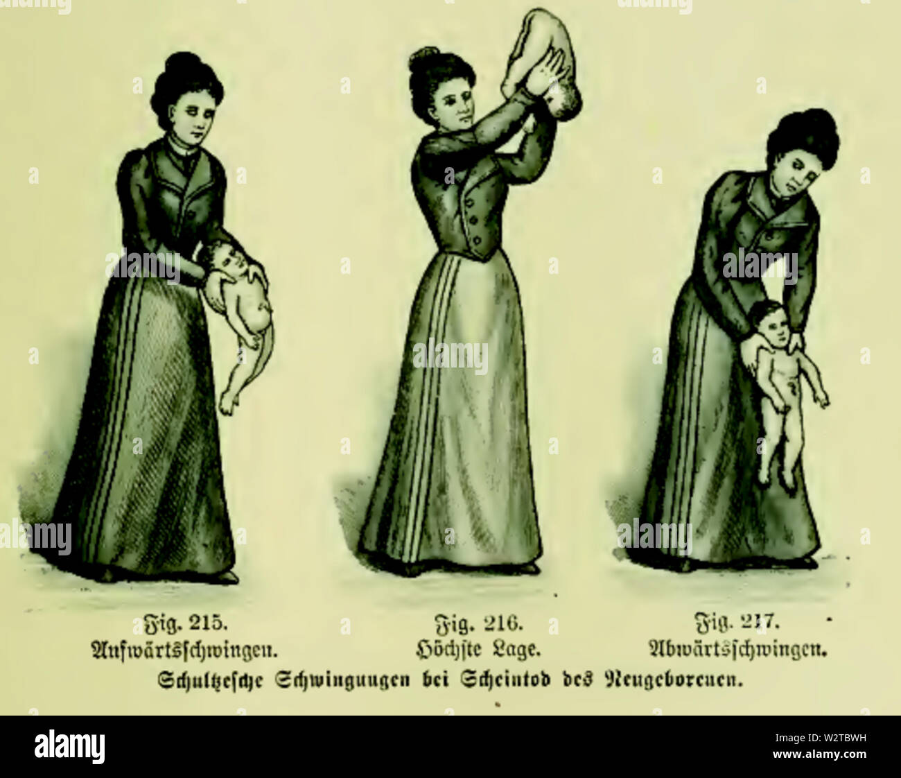 Die Frau als Hausärztin (1911) 215 217 Schultzesche Schwingungen bei Scheintod des Neugeborenen Foto Stock