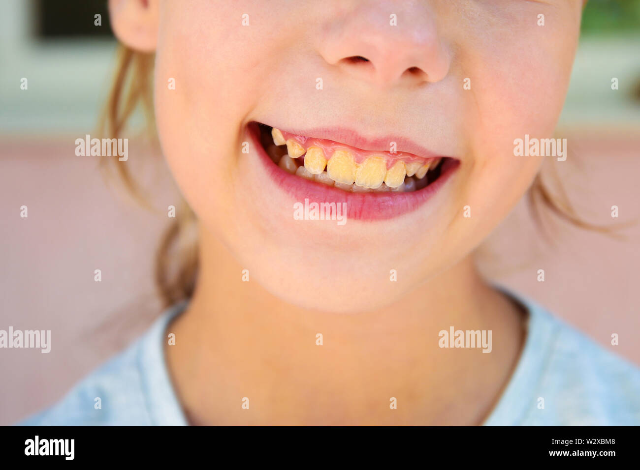 La placca dentale in adolescente. Close up di denti gialli. Foto Stock