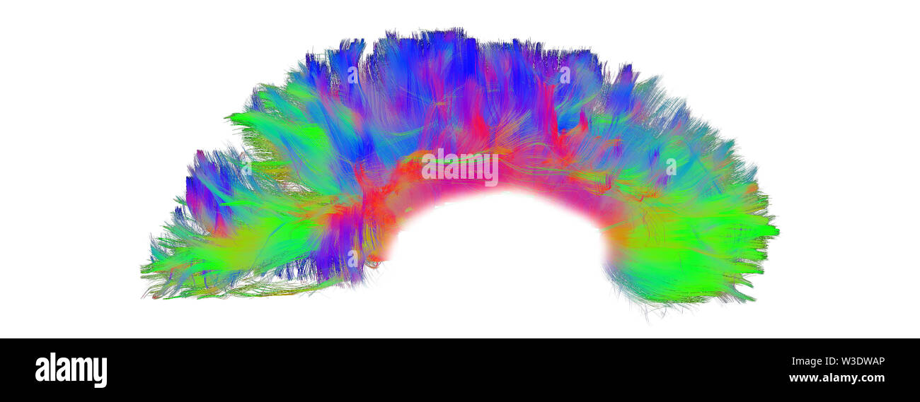 Vista laterale del corpo calloso del cervello umano tramite fibra tractography. Foto Stock