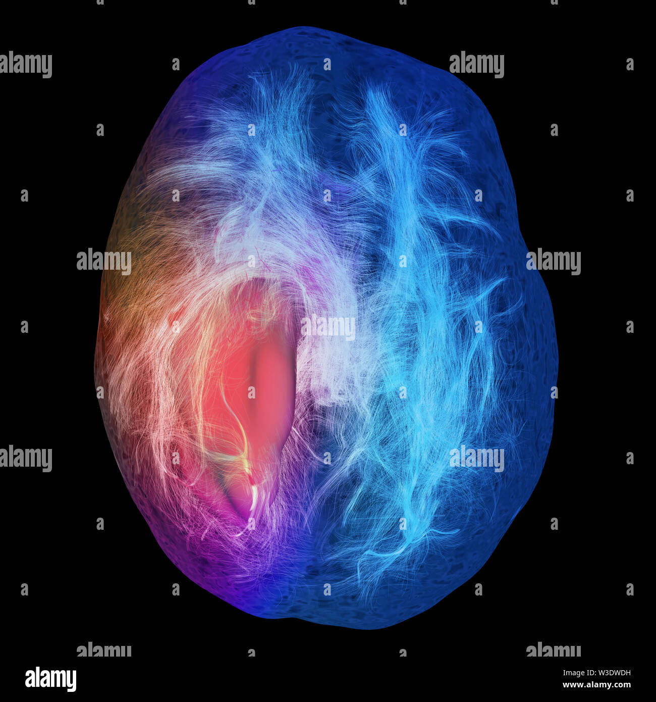 Vista laterale del corpo calloso del cervello umano tramite fibra tractography. Foto Stock