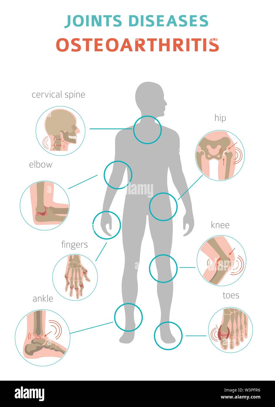 Artrite, artrosi medical design infografico. Sostituzione del giunto, implantant. Illustrazione Vettoriale Illustrazione Vettoriale