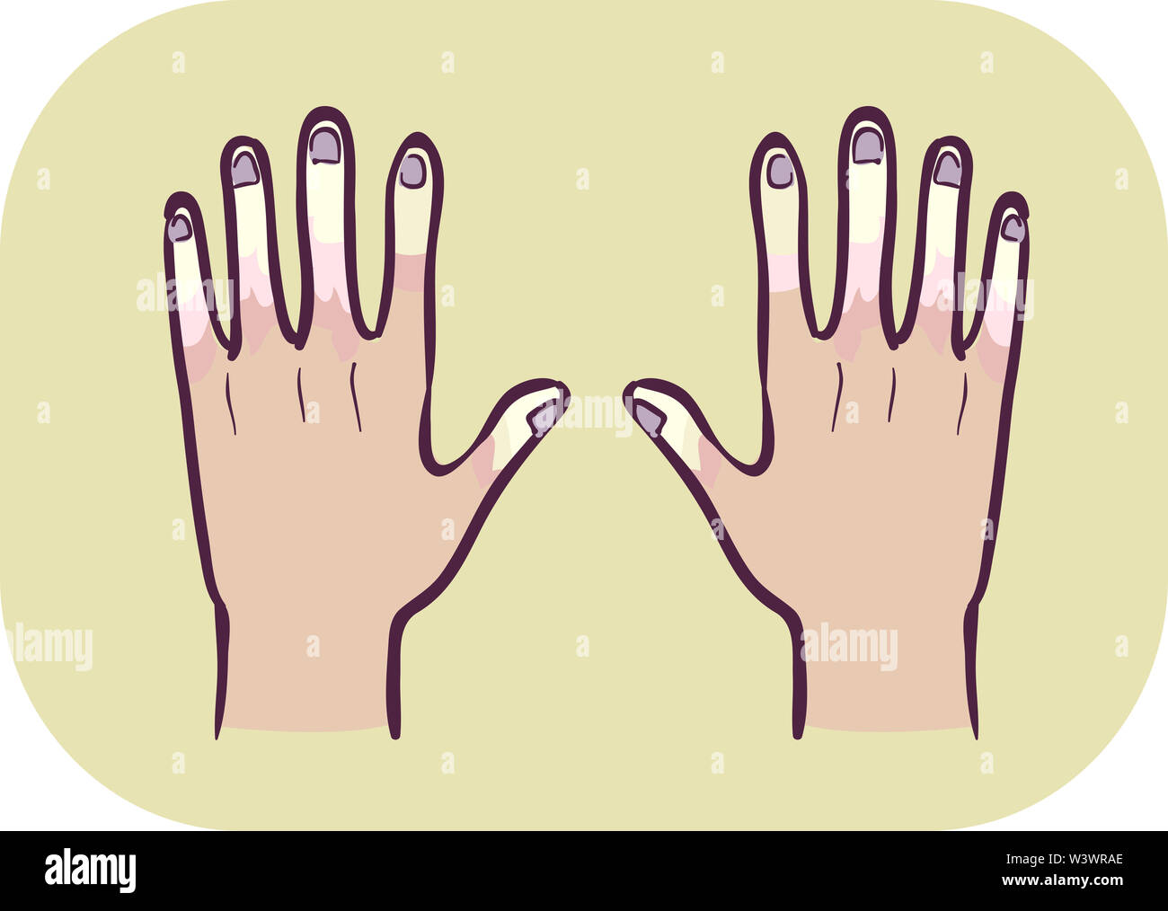 Illustrazione delle mani con Raynauds malattia con bianco e scolorito dita Foto Stock