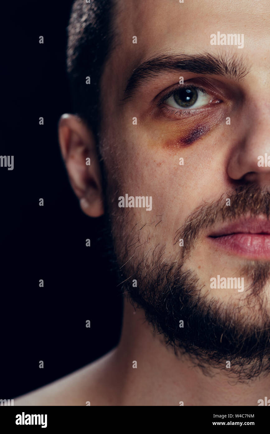 La violenza lotta occhio ematoma shiner close-up. Ritratto di un uomo con la pelle di contusione e occhio nero. Foto Stock