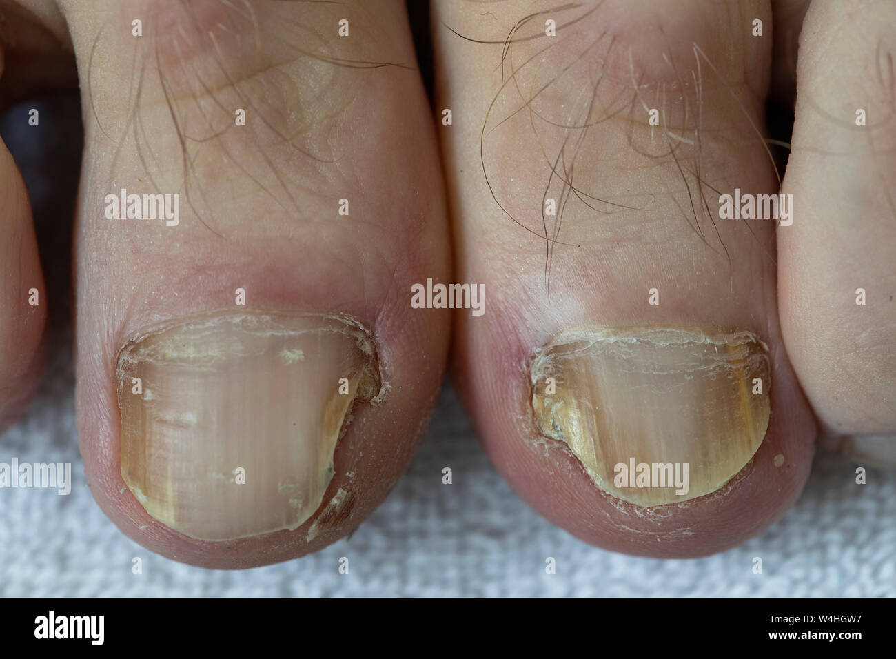 Piedi, toenails, con unghia fungo infestazione, Foto Stock