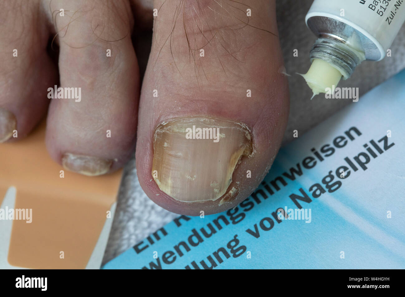 Piedi, toenails, con unghia fungo infestazione, unguento, anti unguento a fungo Foto Stock