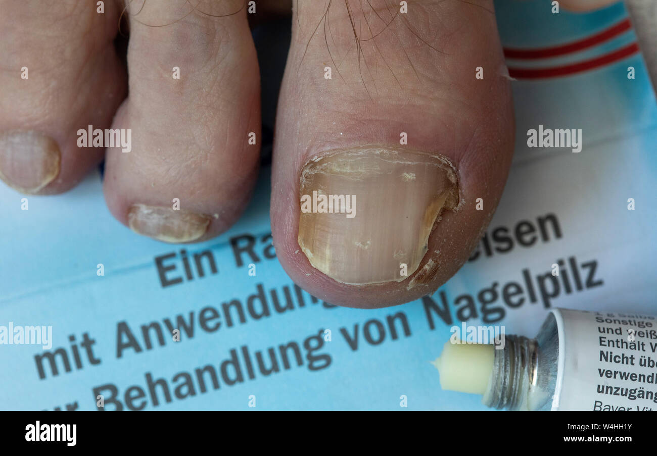 Piedi, toenails, con unghia fungo infestazione, unguento, anti unguento a fungo Foto Stock