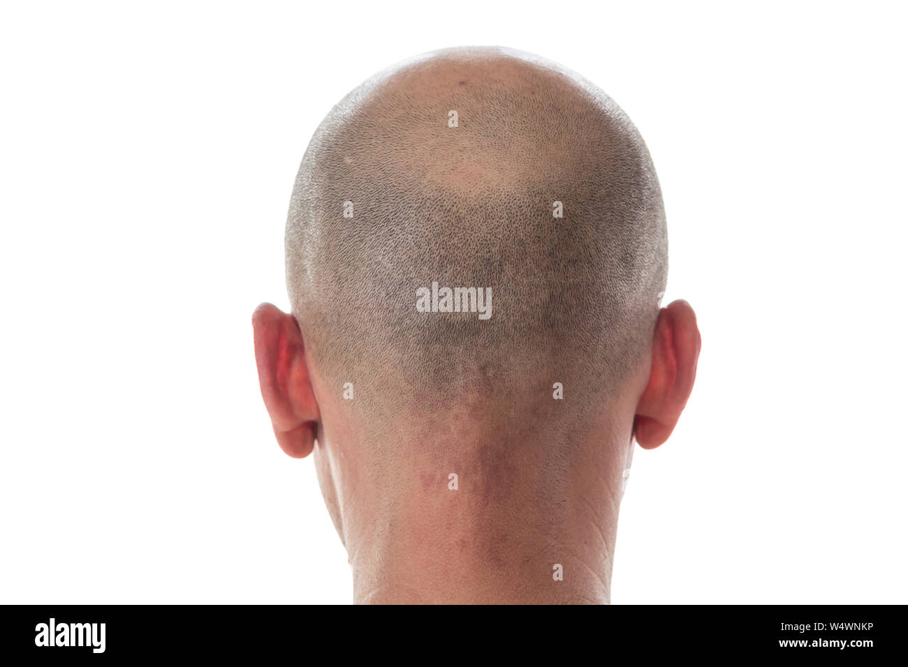 Uomo calvo vista posteriore, testa con perdita di capelli Foto Stock