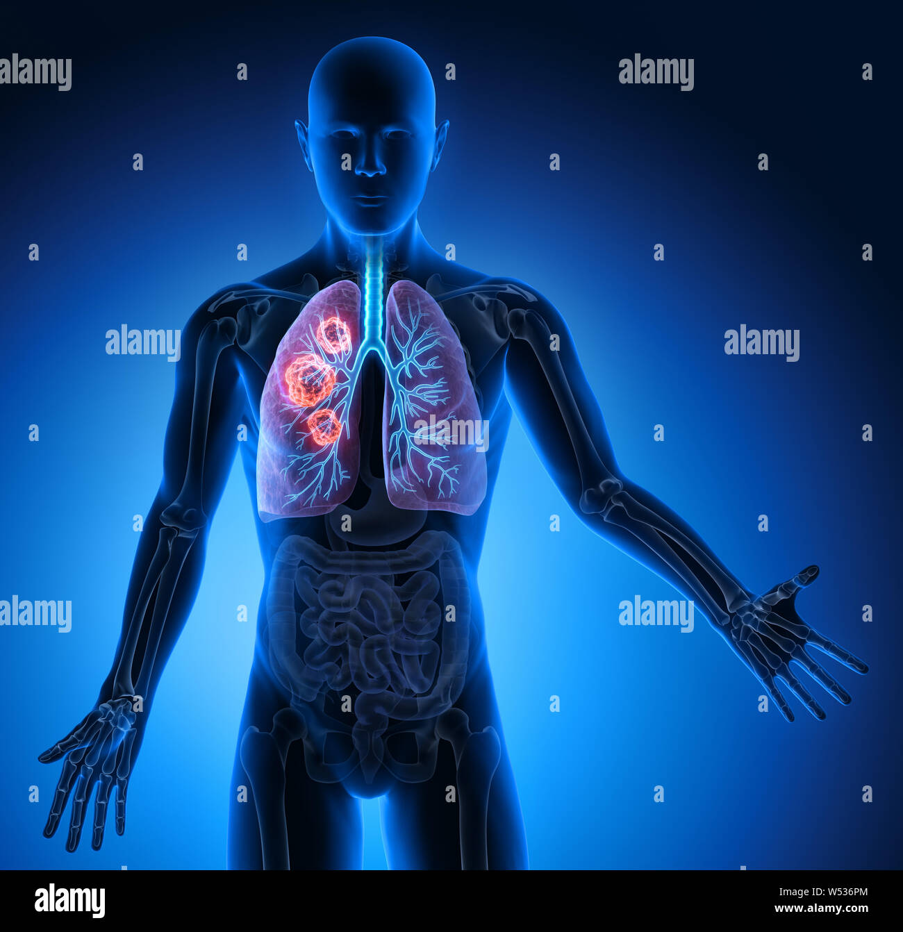 Corpo Umano - polmoni con tumori - 3d illustrazione- 3d illustrazione Foto Stock