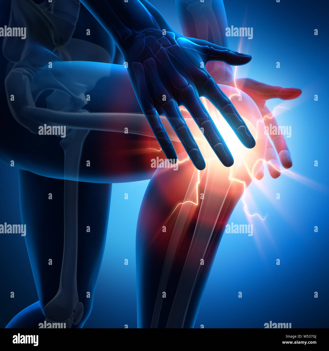 Forte dolore nel giunto del ginocchio - 3D illustrazione Foto Stock