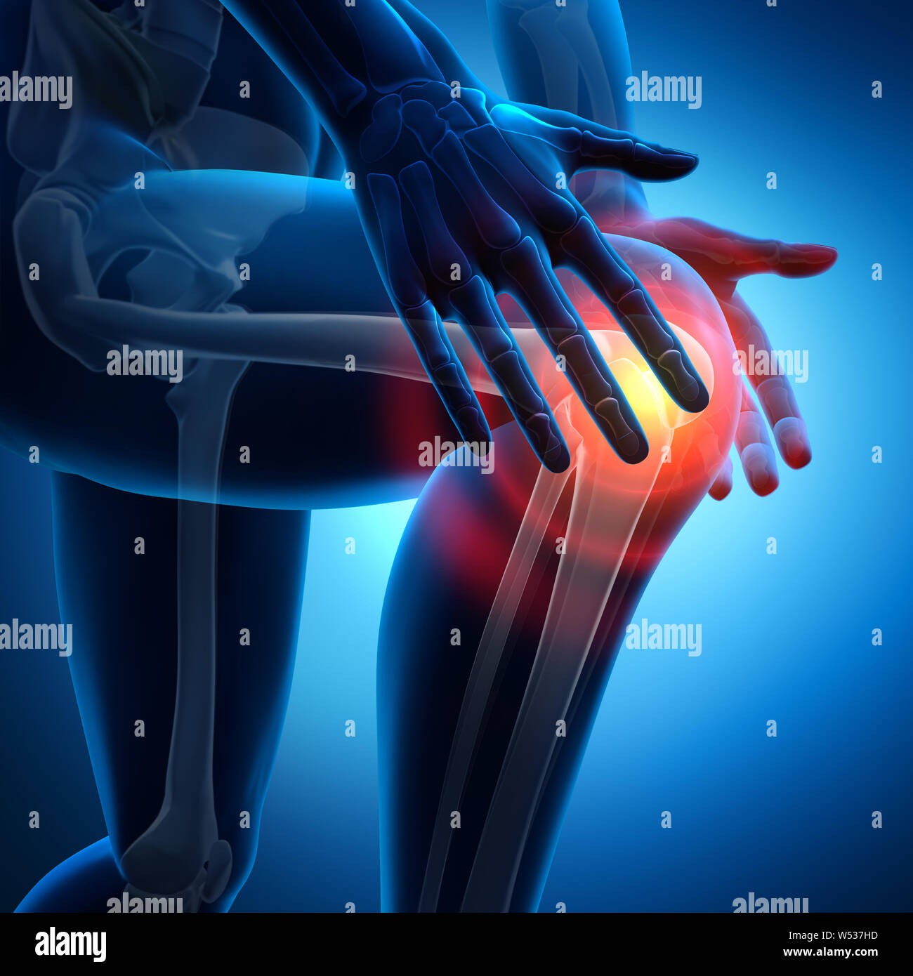 Forte dolore nel giunto del ginocchio - 3D illustrazione Foto Stock