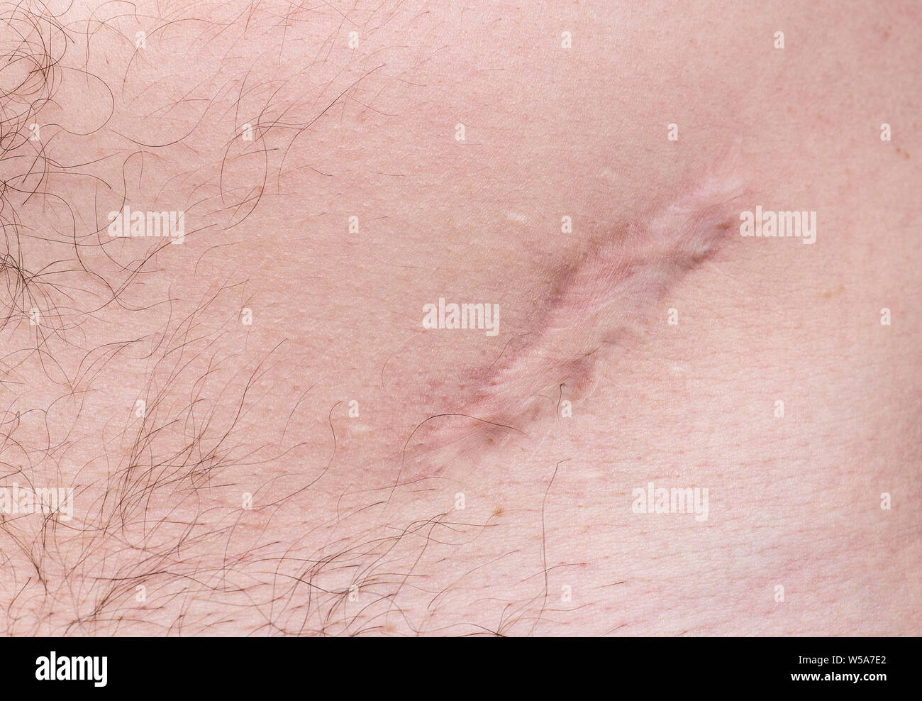 Cicatrice sulla pelle umana ferita o cicatrice dopo funzionamento su stomaco Foto Stock