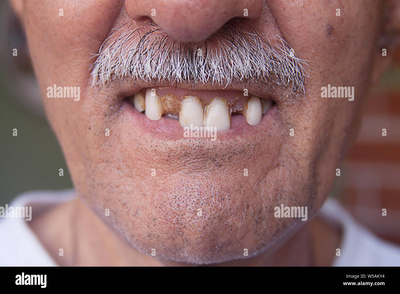 Denti malsano. Bad cure dentarie. Senior uomo denti Foto Stock