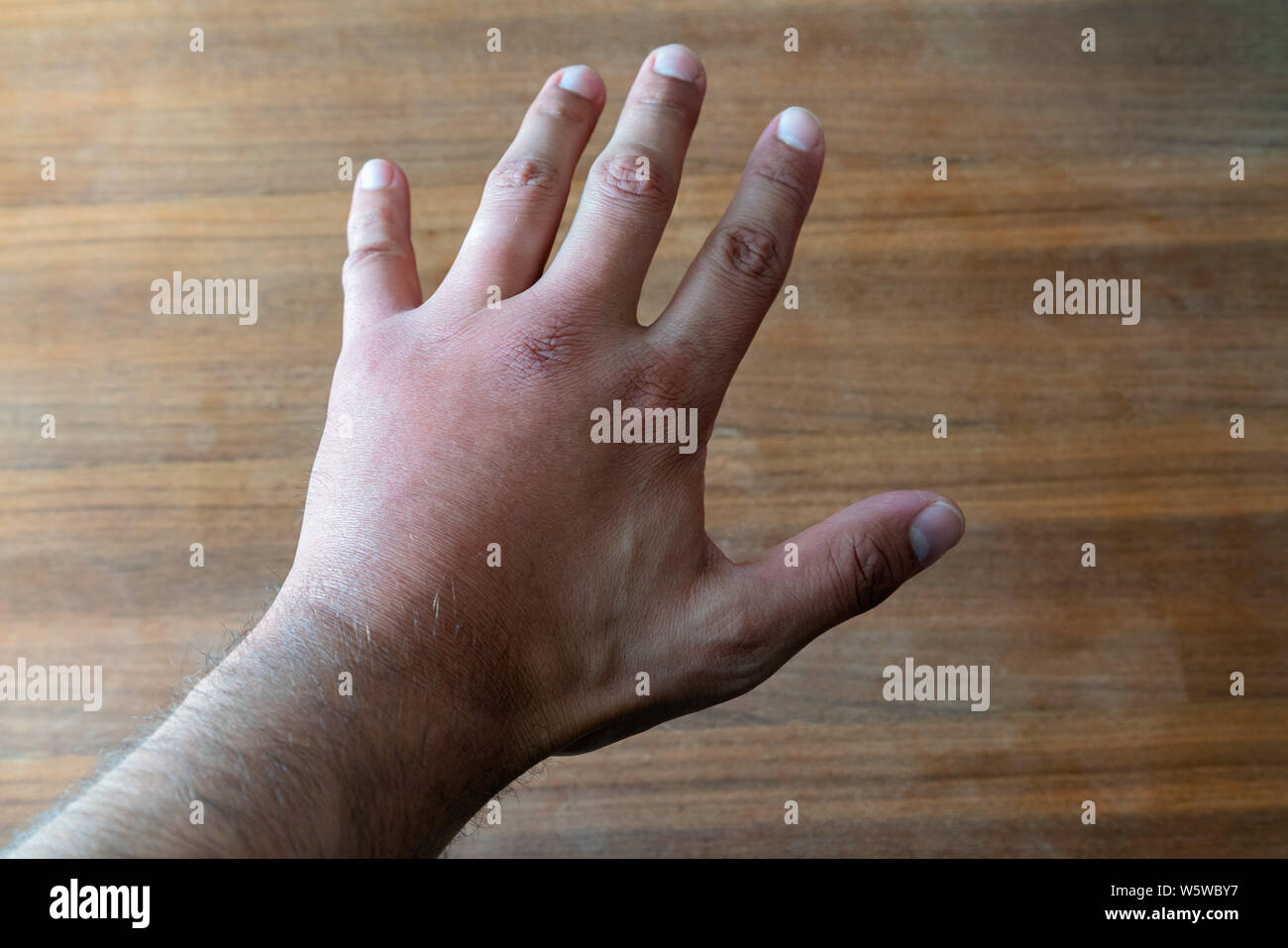 Maschio lato colpito da delle api o vespe. Il rigonfiamento a mano, infiammazione, arrossamento sono segni di infezione. Morso di insetto sulla mano sinistra sul tavolo di legno sfondo Foto Stock