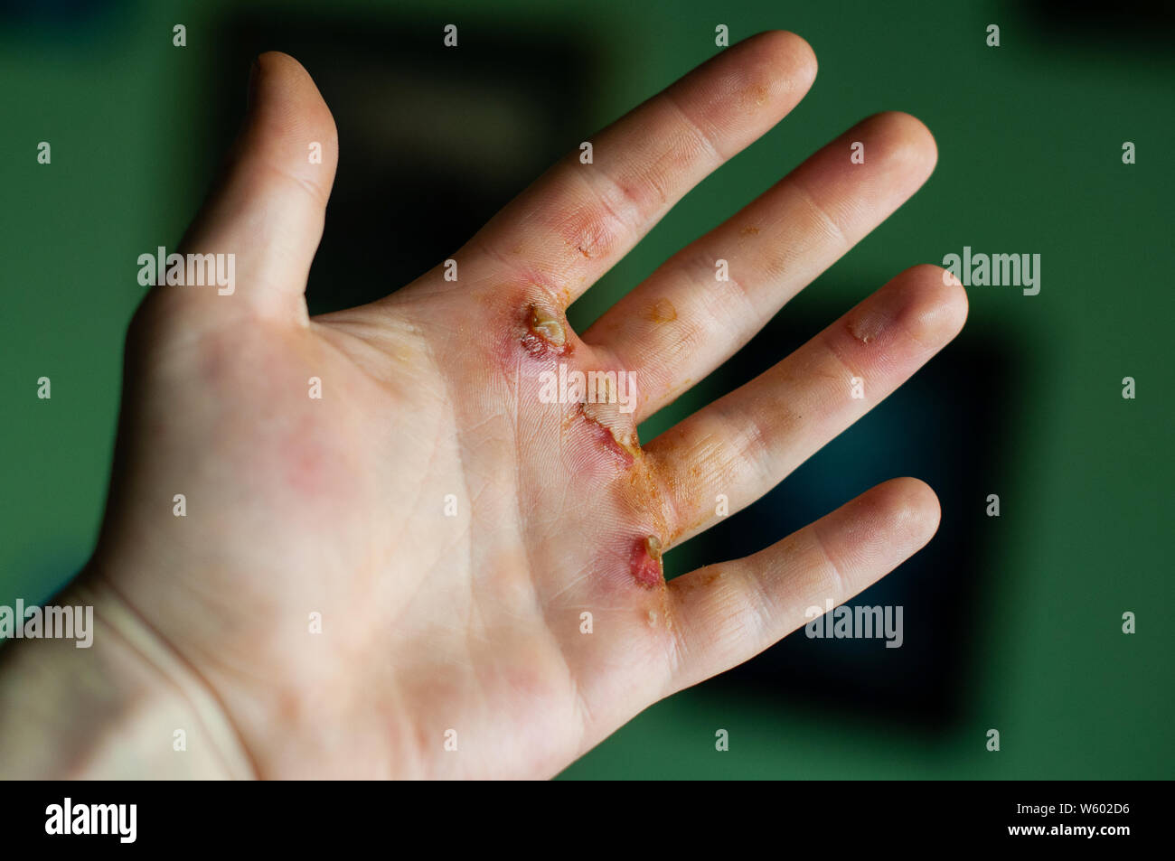 Deep vesciche sulla mano, concetto di immagine, lavorando troppo duro Foto Stock