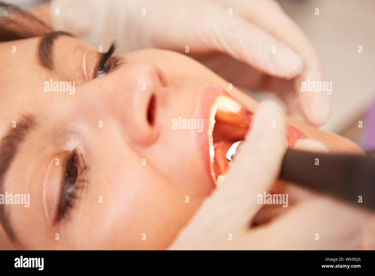 Paziente con il mal di denti e bocca aperta ottiene il trattamento canalare presso il dentista Foto Stock