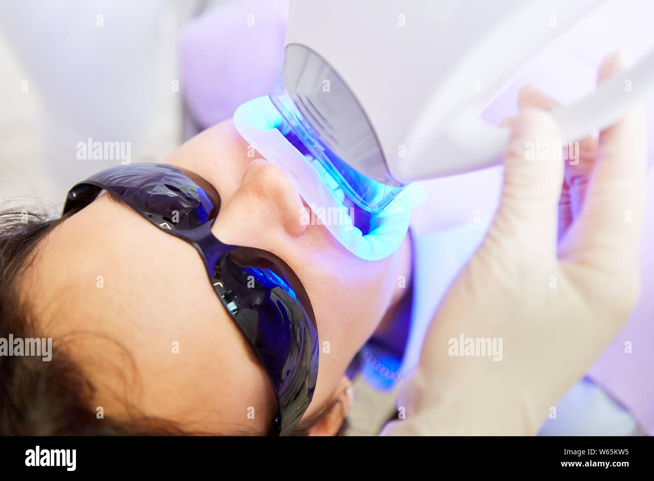 Luce LED blu a luce fredda è utilizzato in attività professionali di sbiancamento dei denti Foto Stock