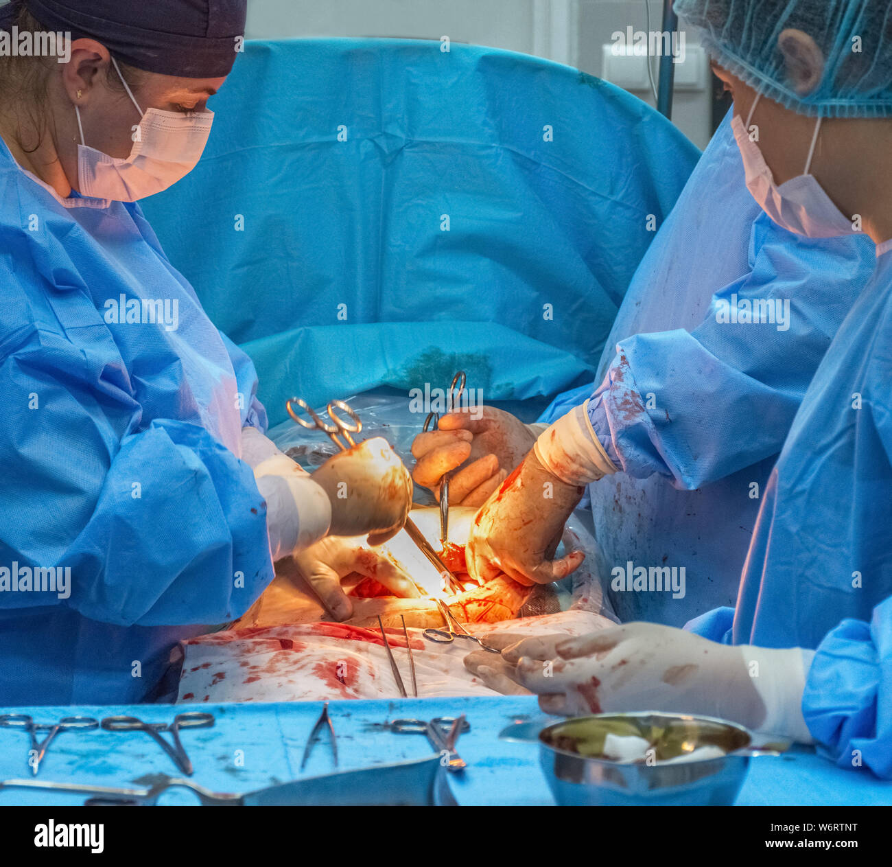 Medico équipe chirurgica in sala operatoria degli addominali taglio cesareo durante il parto. Foto Stock