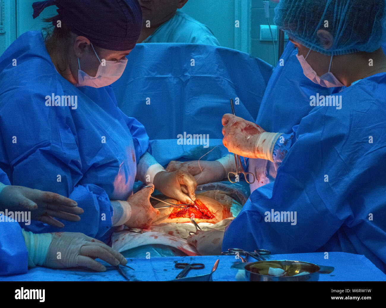 Medico équipe chirurgica in sala operatoria degli addominali taglio cesareo durante il parto. Foto Stock