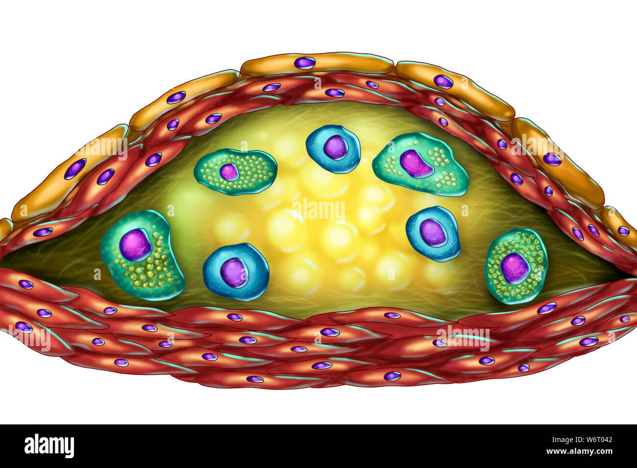 Struttura della placca aterosclerotica, illustrazione del computer. Il centro necrotico, cellule di schiuma e linfociti T sono visibili all'interno della placca di colesterolo. Le pareti sono fatte di cellule di muscolo liscio ed endotelio dal vaso sanguigno. Foto Stock