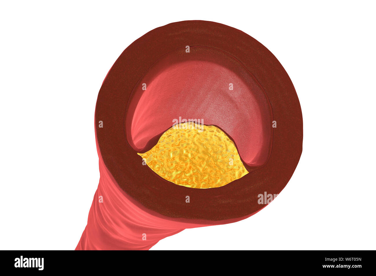 Placche ateromatose all'interno del vaso sanguigno, illustrazione del computer. Un colesterolo ateroma sta causando un restringimento di una arteria (aterosclerosi). Foto Stock