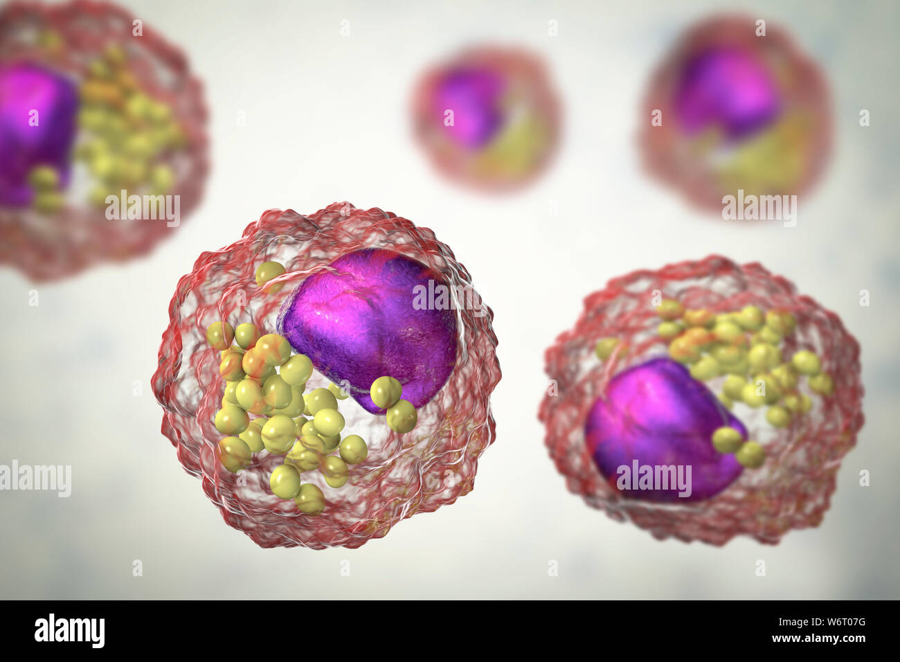 Schiuma di macrofago cellula, illustrazione. Cellule di schiuma sono le cellule di macrofago che contengono goccioline lipidiche e sono componenti della placca aterosclerotica. Foto Stock