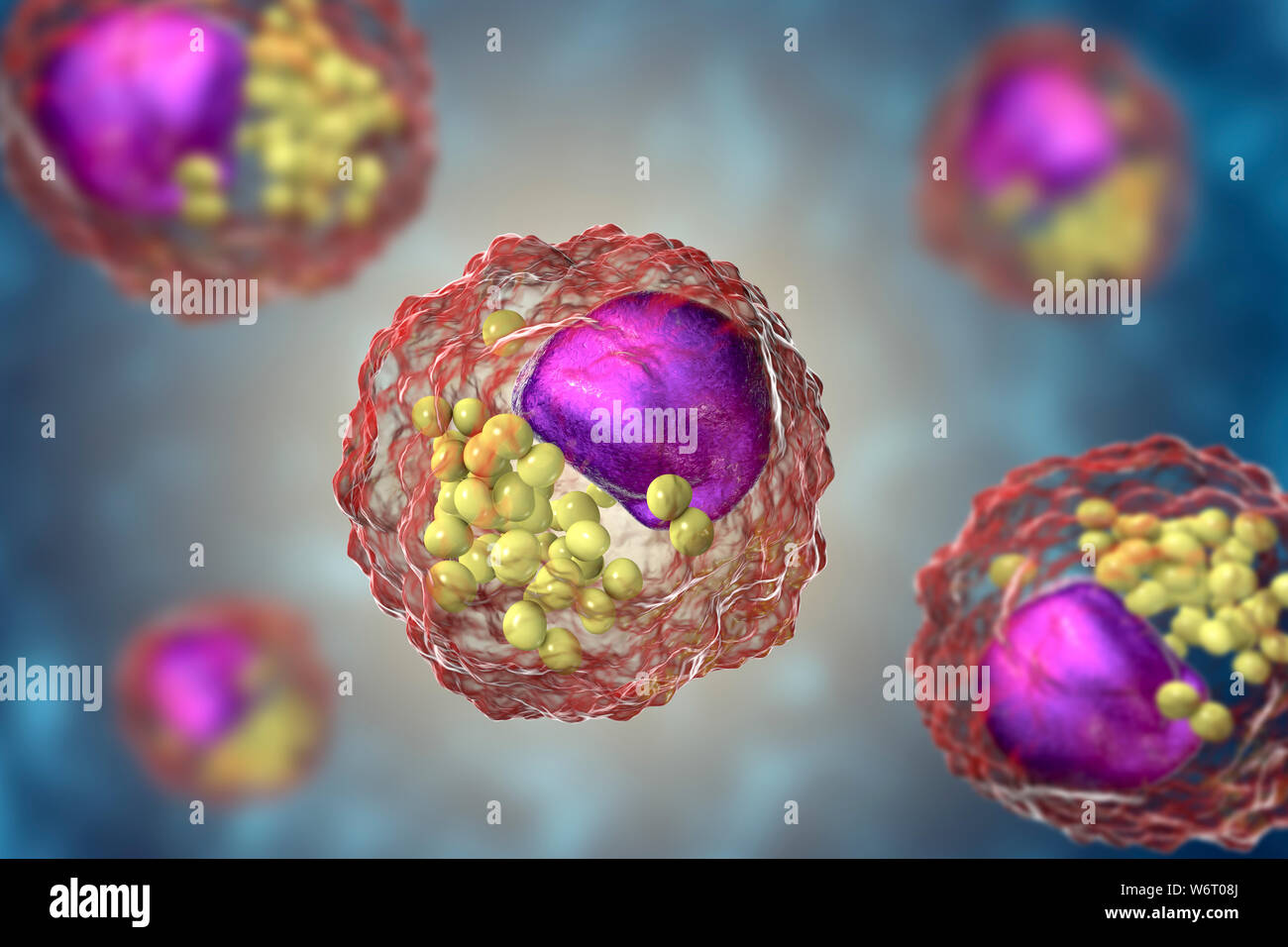 Schiuma di macrofago cellula, illustrazione. Cellule di schiuma sono le cellule di macrofago che contengono goccioline lipidiche e sono componenti della placca aterosclerotica. Foto Stock