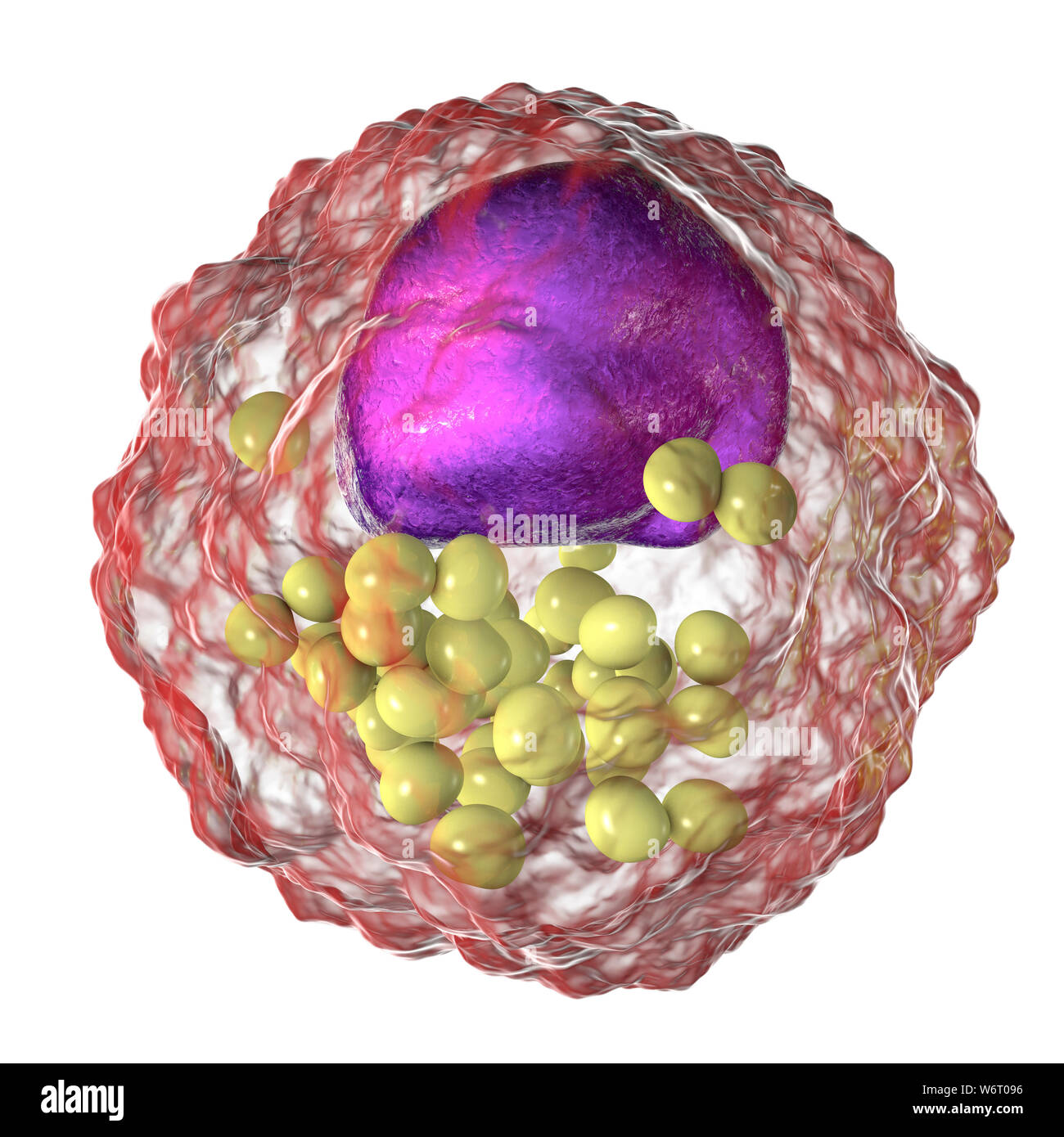 Schiuma di macrofago cellula, illustrazione. Cellule di schiuma sono le cellule di macrofago che contengono goccioline lipidiche e sono componenti della placca aterosclerotica. Foto Stock