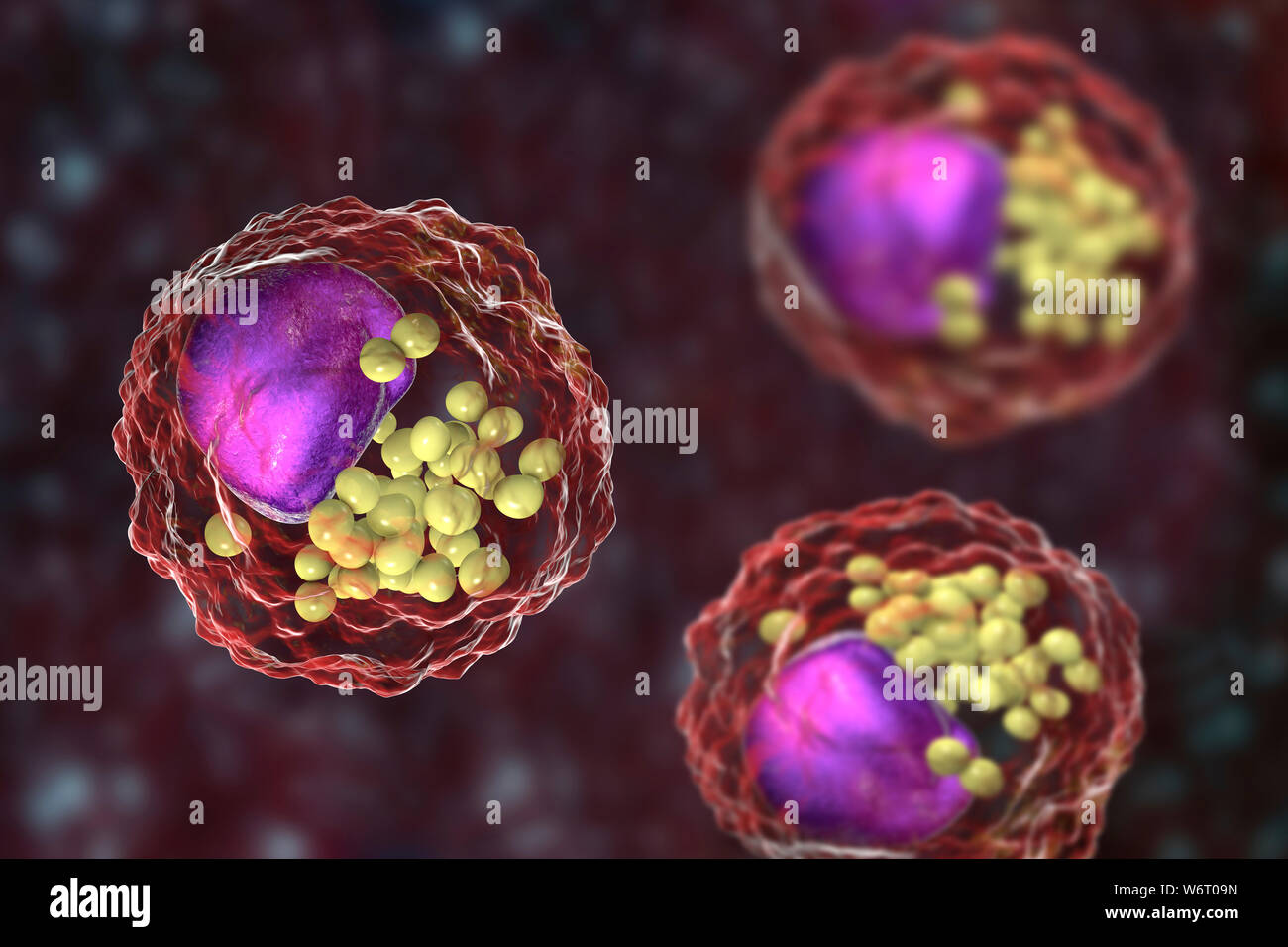 Schiuma di macrofago cellula, illustrazione. Cellule di schiuma sono le cellule di macrofago che contengono goccioline lipidiche e sono componenti della placca aterosclerotica. Foto Stock