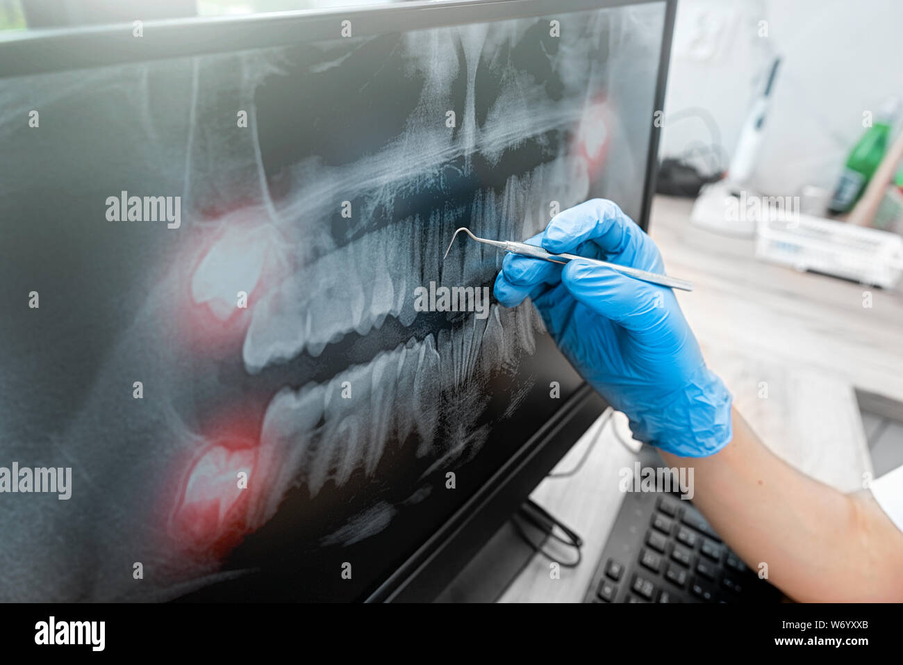 Medico guardando a denti umani x-ray sul monitor del computer. Un moderno studio dentistico. Foto Stock