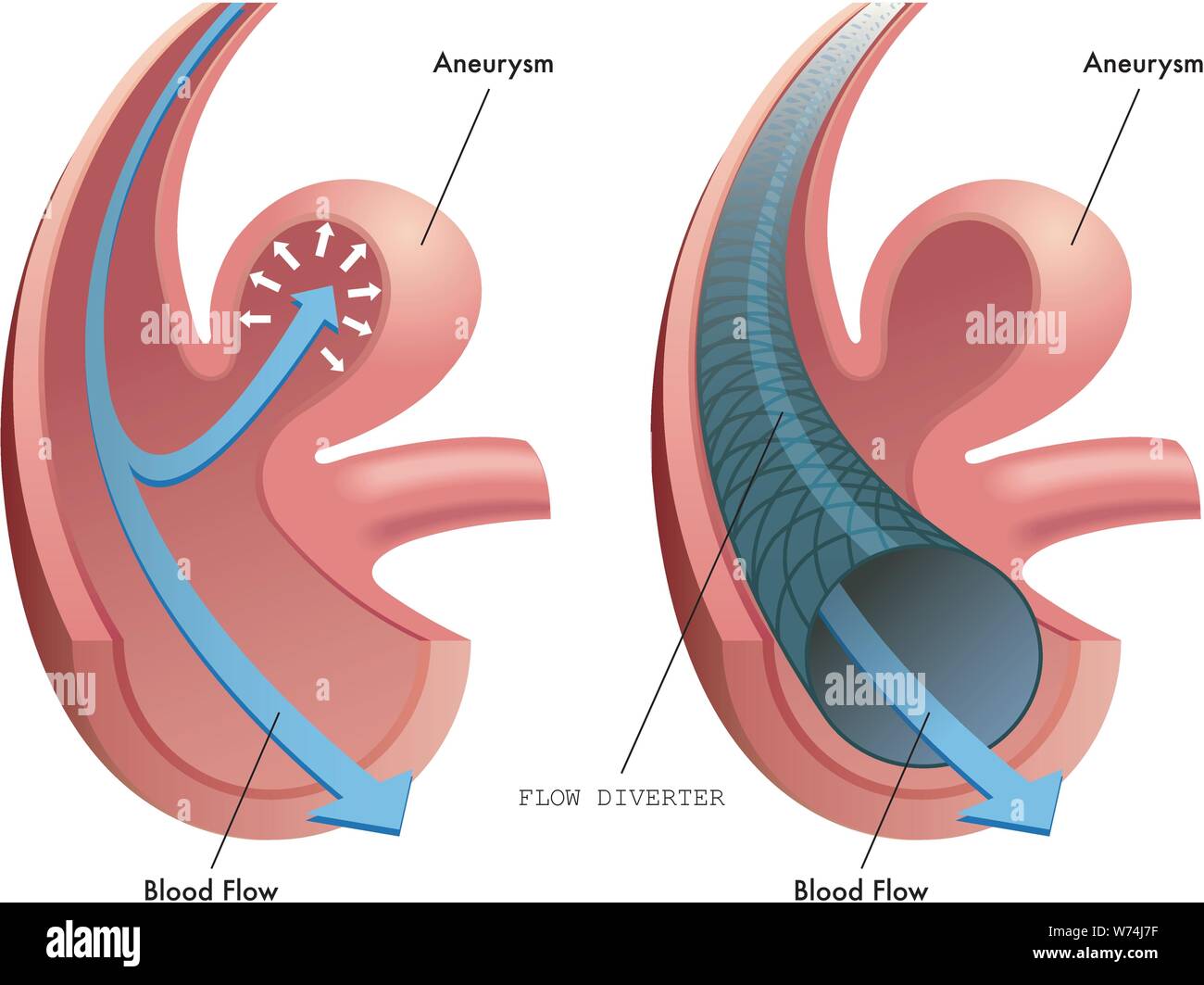 Illustrazione medica della funzione del deviatore di flusso Illustrazione Vettoriale