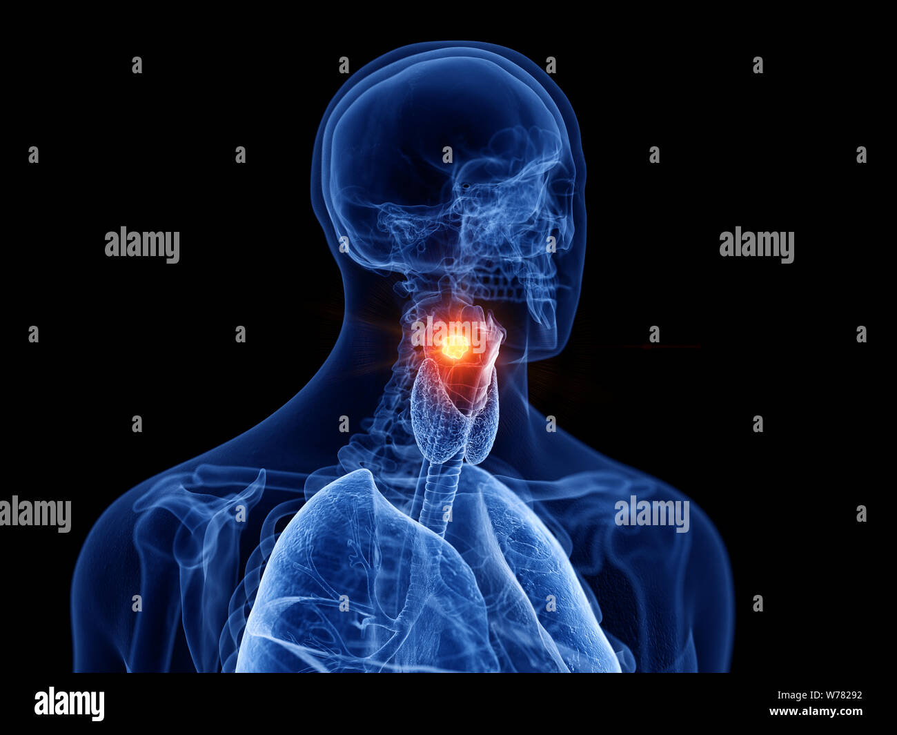 3D Rendering accurato dal punto di vista medico illustrazione del cancro della laringe Foto Stock