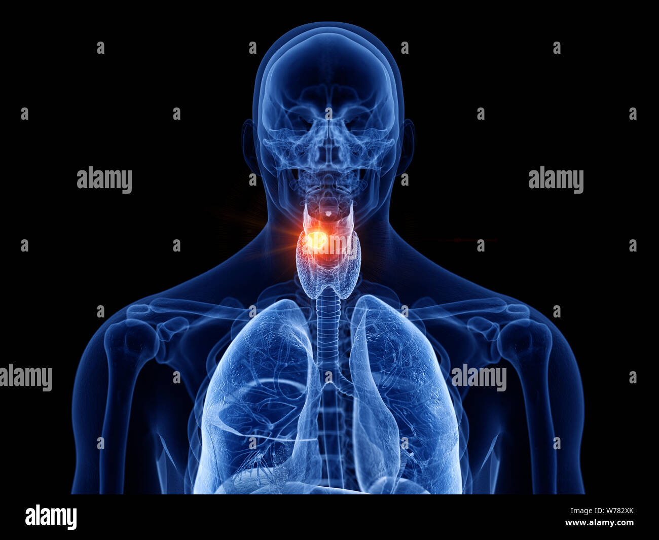 3D Rendering accurato dal punto di vista medico illustrazione del cancro della laringe Foto Stock