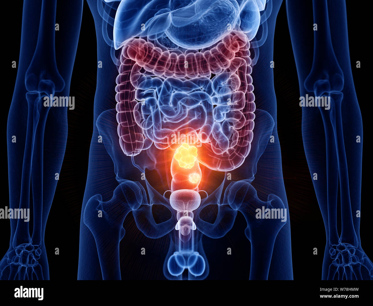3D Rendering accurato dal punto di vista medico illustrazione di cancro al colon Foto Stock