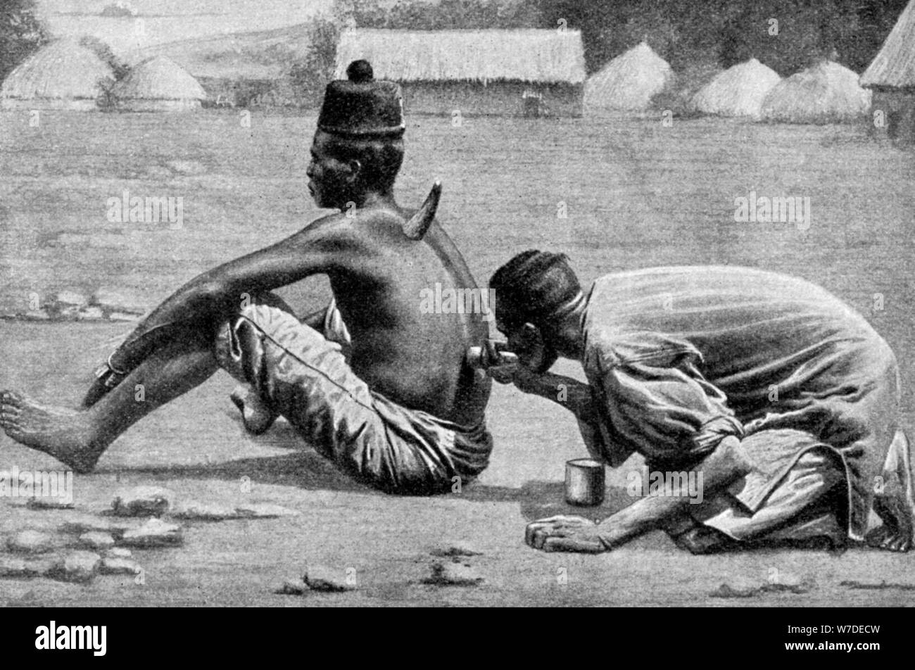 Coppettazione, a umido e a secco, come una misura terapeutica, Africa, 1922.Artista: FW Taylor Foto Stock