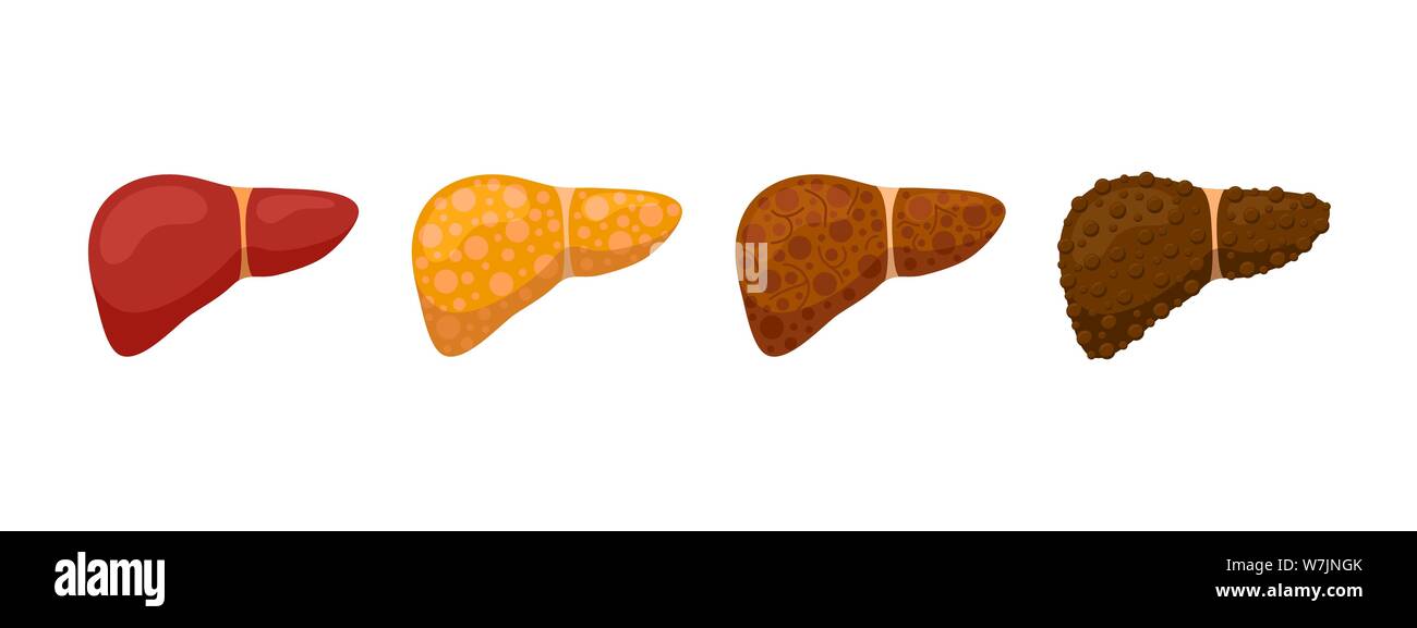 Fasi del concetto di danno epatico umano. Steatosi epatica sana fibrosi e cirrosi. Vettore cartoon medico reversibile e irreversibile condizione illustrazione Illustrazione Vettoriale